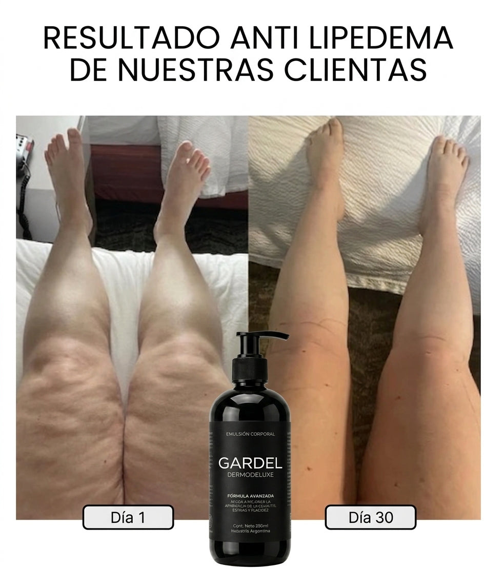 GARDEL DERMODELUXE - PARA LIPEDEMA Y CELULITIS AVANZADA